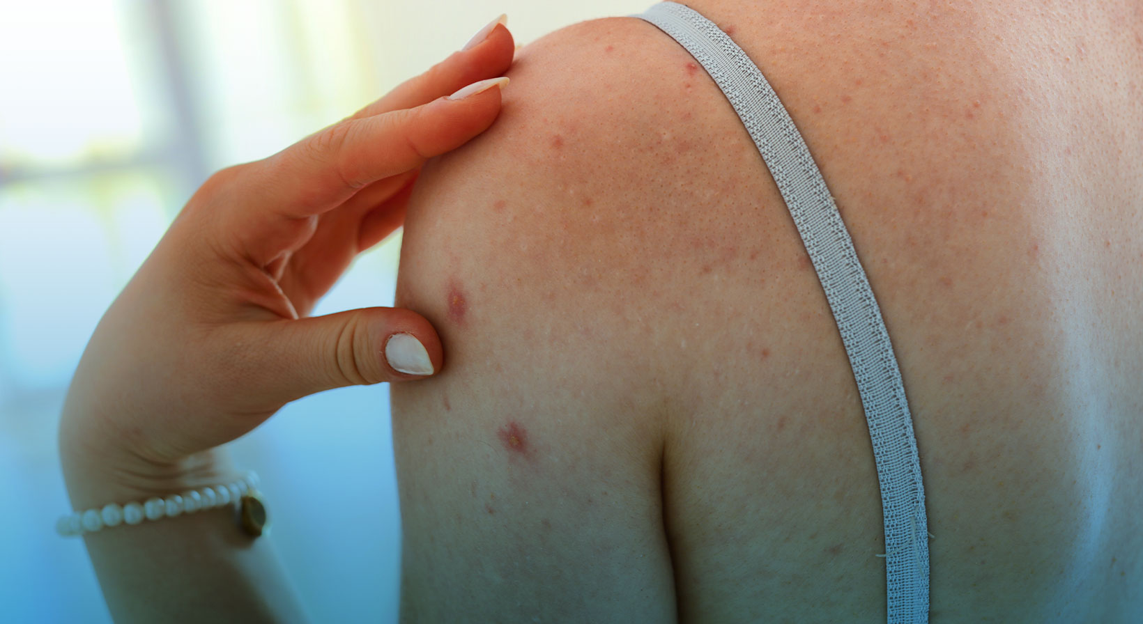 Imagem mostra as costas de uma mulher que sofre de Dermatite Atópica