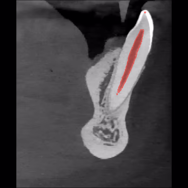 Sagittal CBCT slice