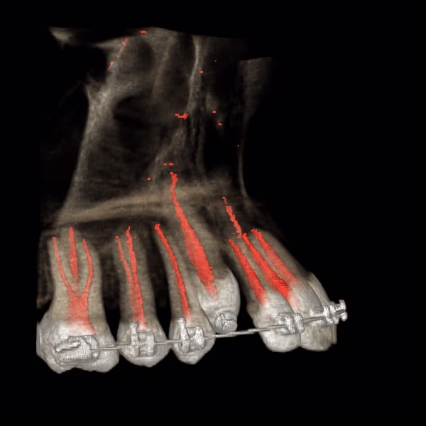 3D reconstruction of a dental CBCT scan segmented by PrognosiX AI