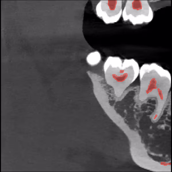 Sagittal CBCT slice