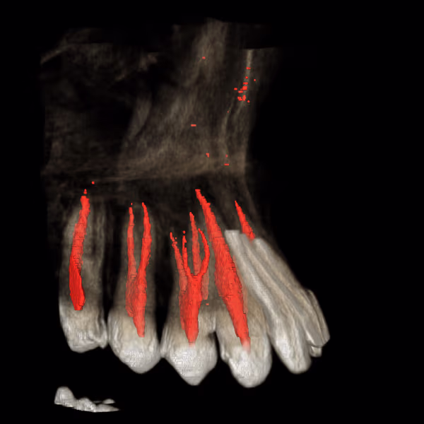 3D bone reconstruction