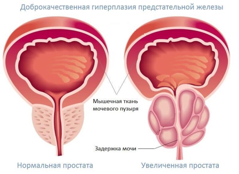 prostatita cu adenom de prostată prostata anatomie zonen