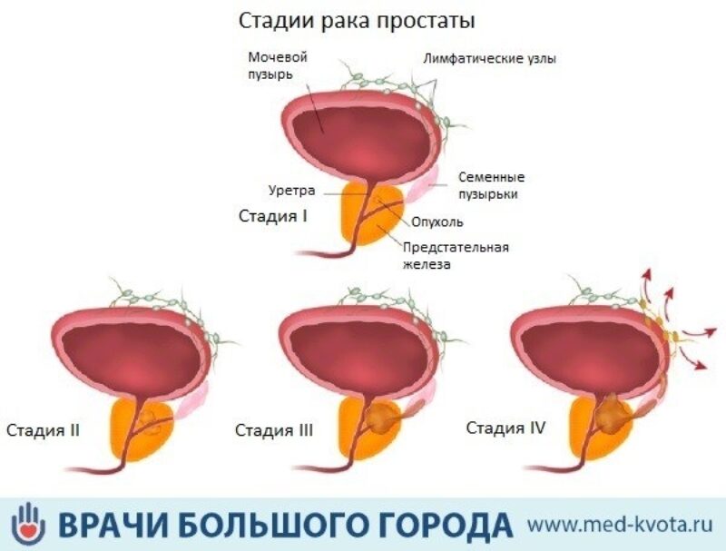 Как быстро снять симптомы простатита Как определить рак простаты - причины, на что обратить внимание, методы исследов