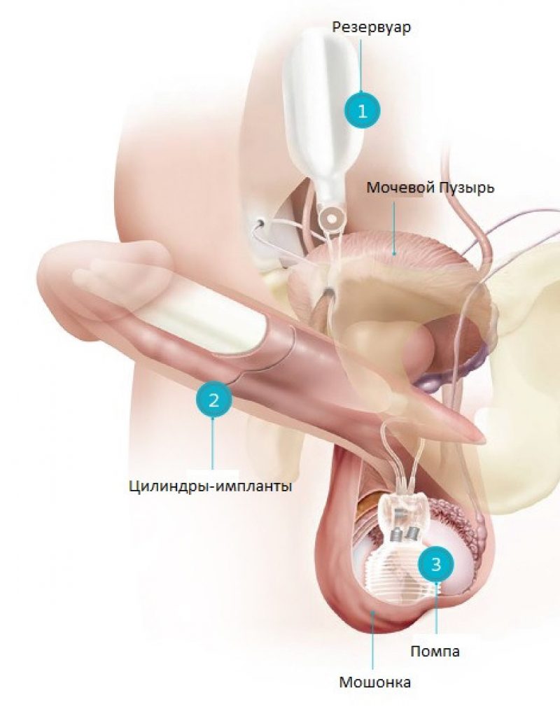 Лечение эректильной дисфункции – метод протезирования, подготовка к операции