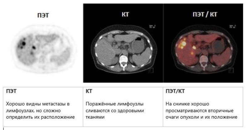 Пэт кт 18f psma что это. Смотреть фото Пэт кт 18f psma что это. Смотреть картинку Пэт кт 18f psma что это. Картинка про Пэт кт 18f psma что это. Фото Пэт кт 18f psma что это