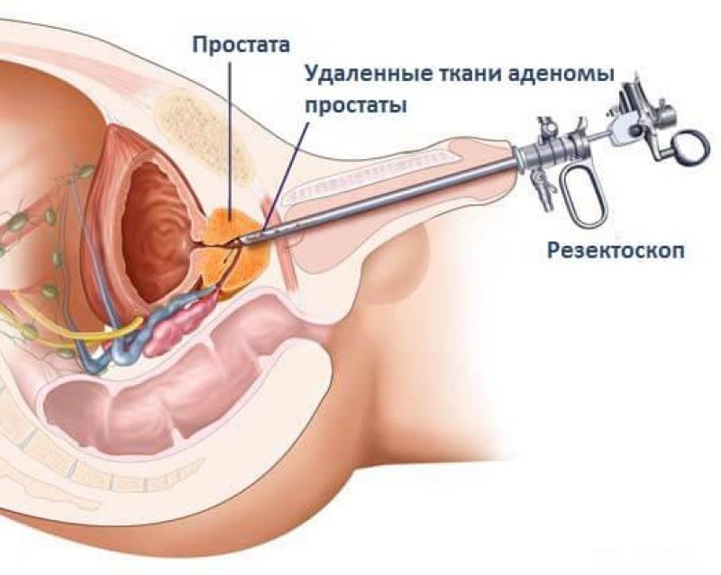 A szanatórium zheleznovsdska prosztata adenoma profilja