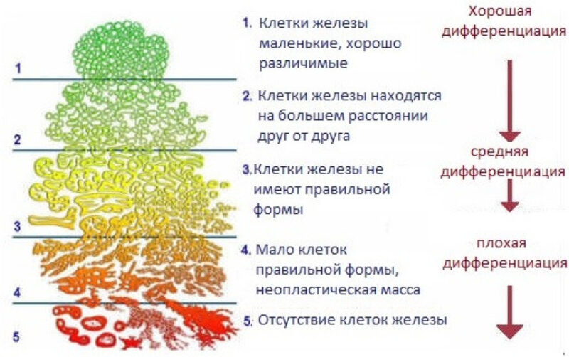 Шкала Глисона