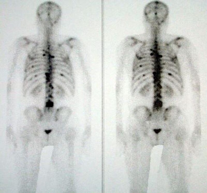 Метастазирование При Раке Простаты