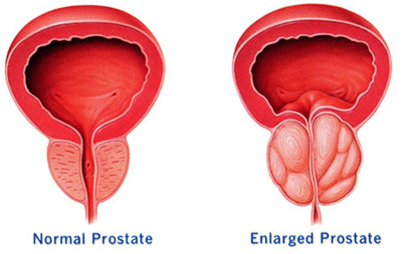 Prospective aspects in the oncological treatment of prostate cancer