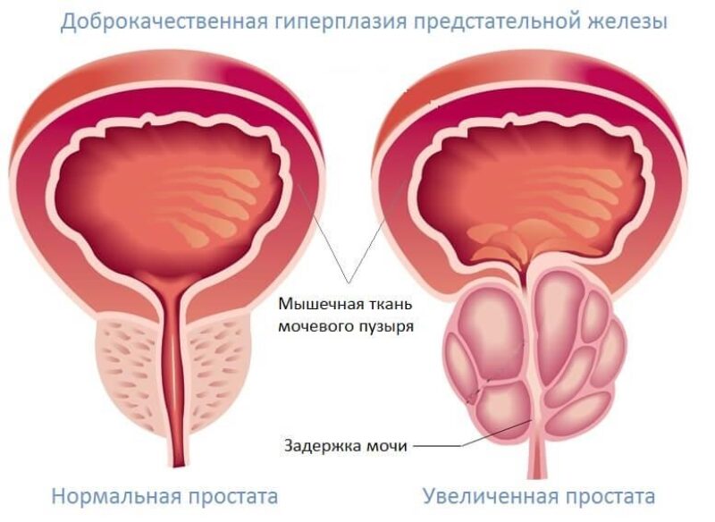 Молитва от аденомы простаты - Моя молитва Лечение аденомы предстательной железы в Сочи