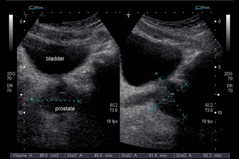 УЗИ предстательной железы и органов мошонки