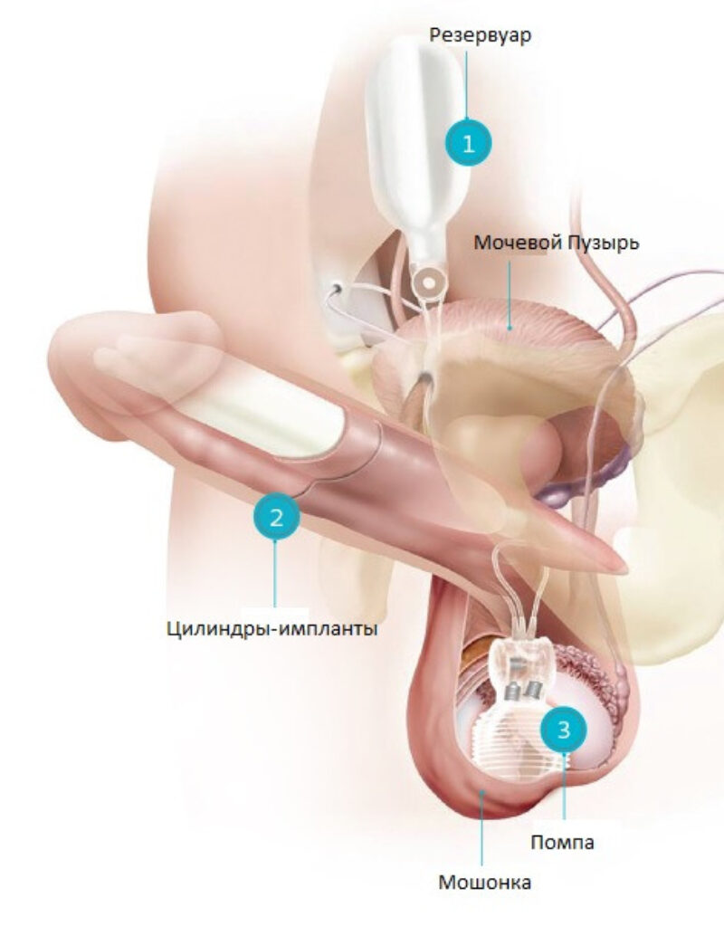 Лечение Эректильной Дисфункции