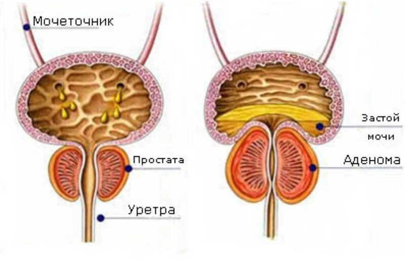 Опухолевые маркеры: рак предстательной железы (РПЖ)