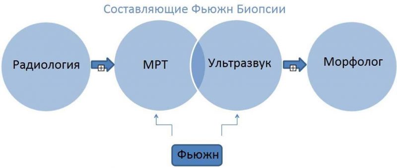 Фьюжн биопсия простаты - самый точный метод биопсии