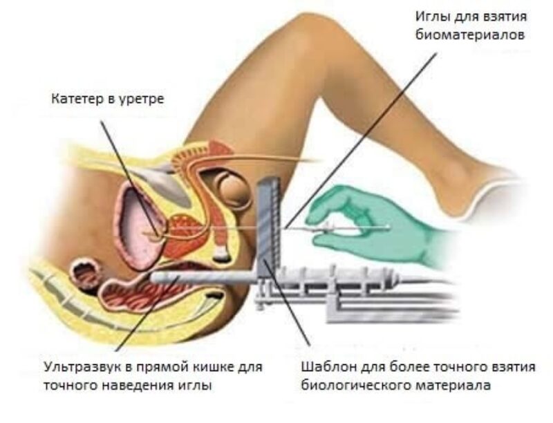 Биопсия предстательной железы (простаты)