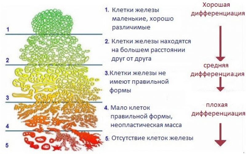 Особенности химиотерапии при раке предстательной железы