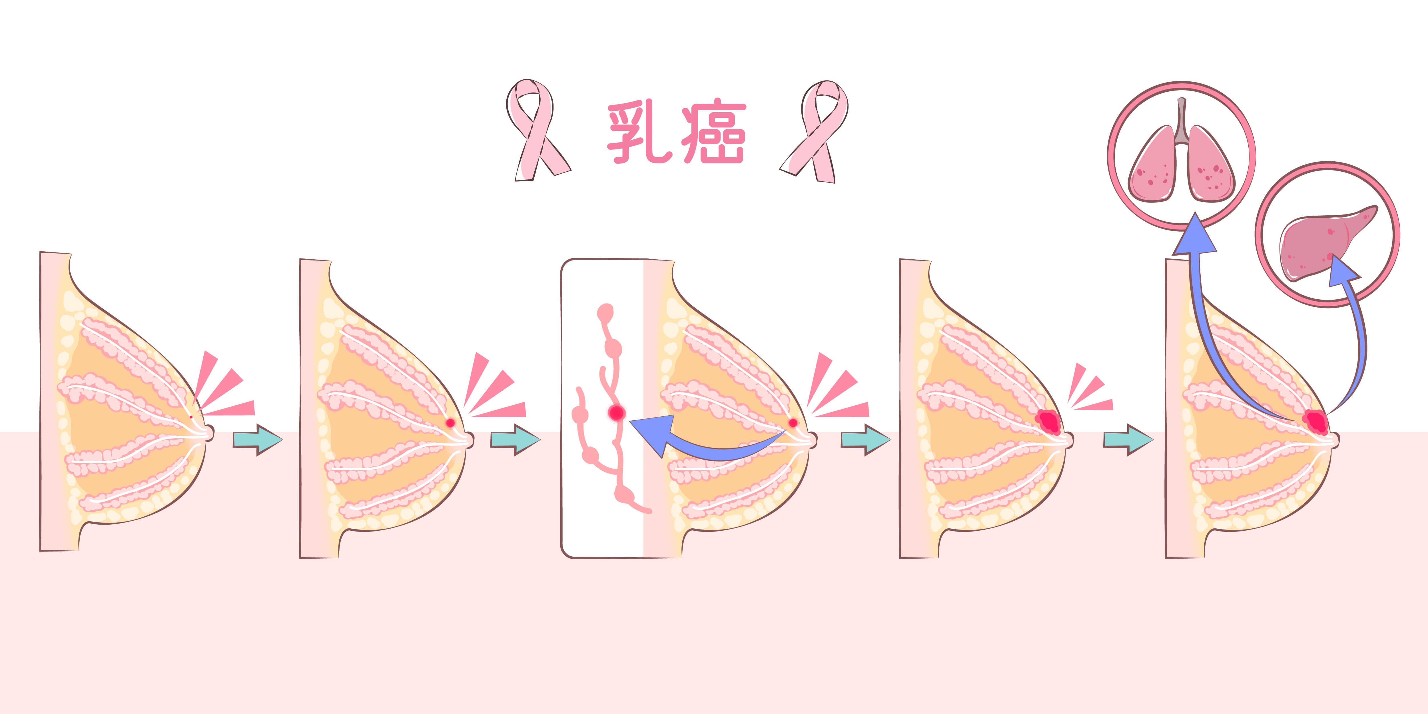 Breast Cancer Type.jpg