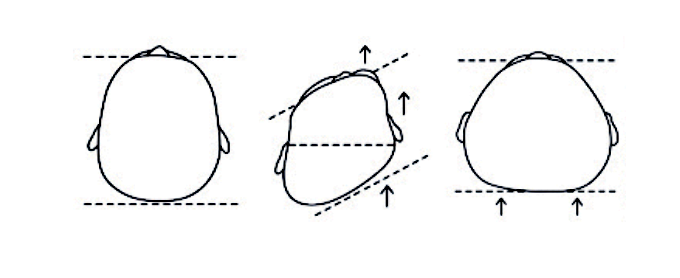 assimetrias cranianas no bebé