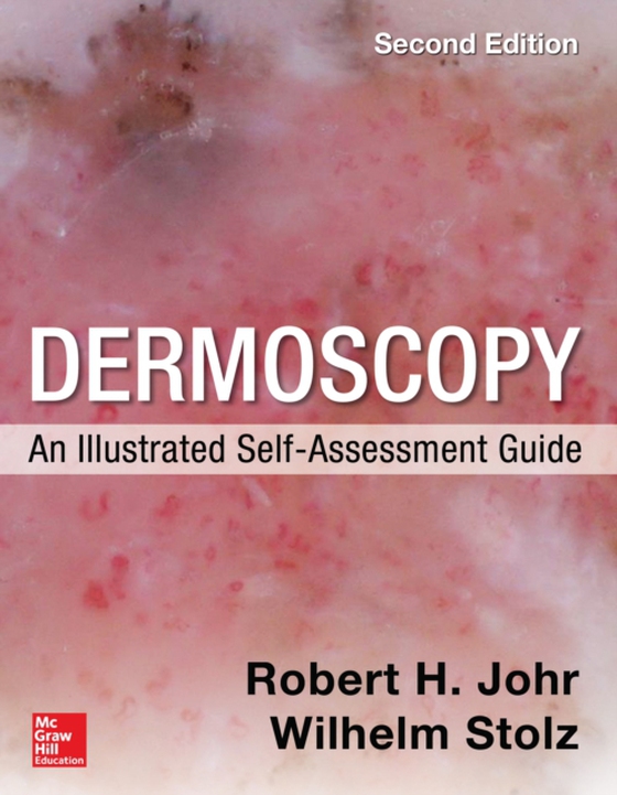 Dermoscopy: An Illustrated Self-Assessment Guide, 2/e (e-bog) af Stolz, Wilhelm
