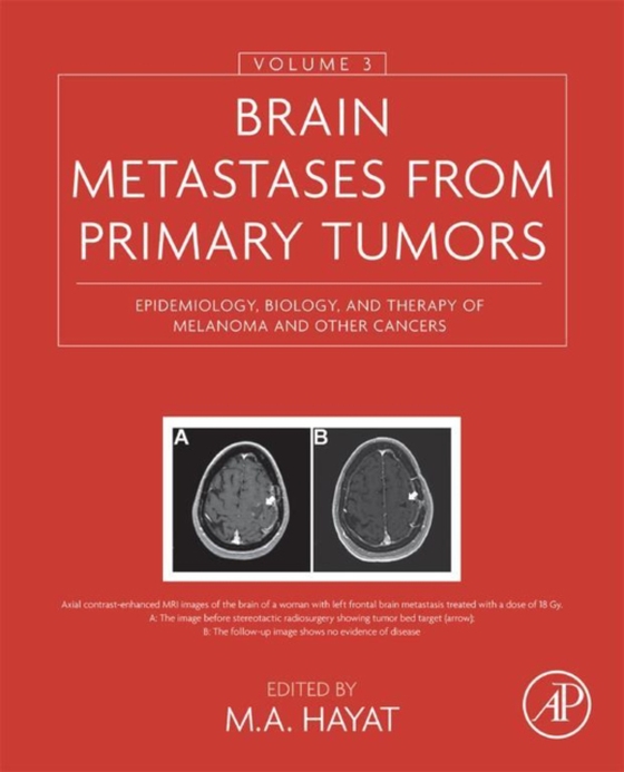 Brain Metastases from Primary Tumors, Volume 3 (e-bog) af -