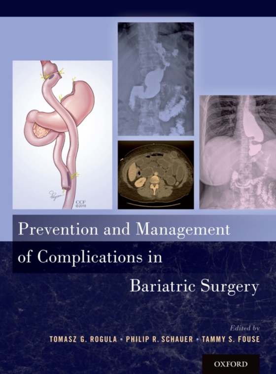 Prevention and Management of Complications in Bariatric Surgery (e-bog) af -