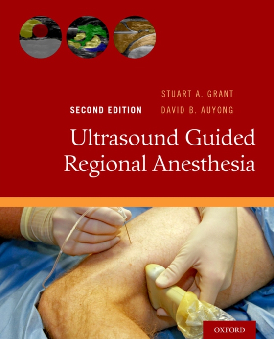 Ultrasound Guided Regional Anesthesia (e-bog) af -