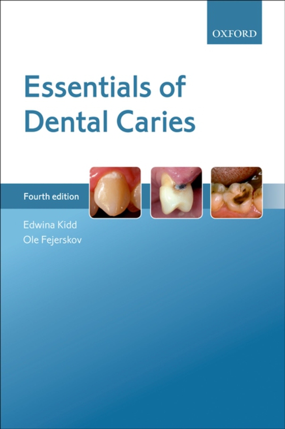 Essentials of Dental Caries (e-bog) af Fejerskov, Ole