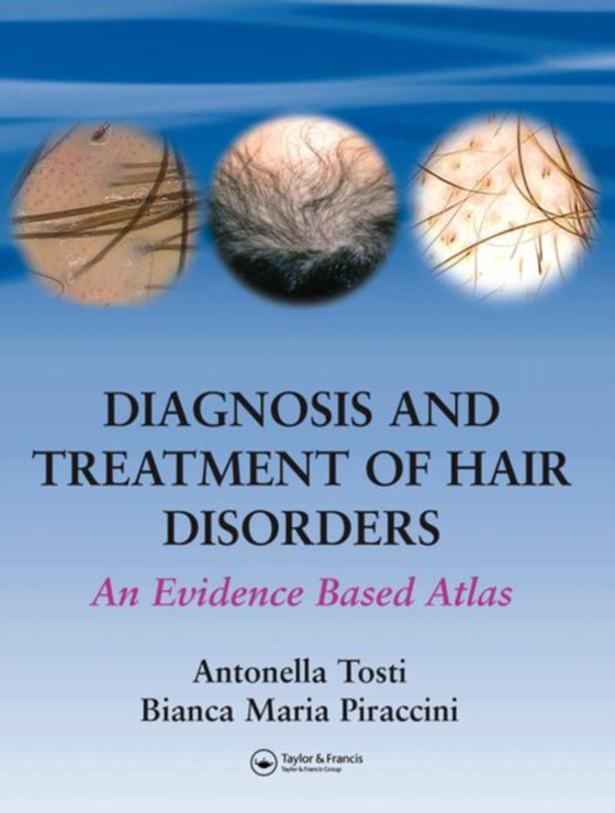 Diagnosis and Treatment of Hair Disorders (e-bog) af Piraccini, Bianca Maria