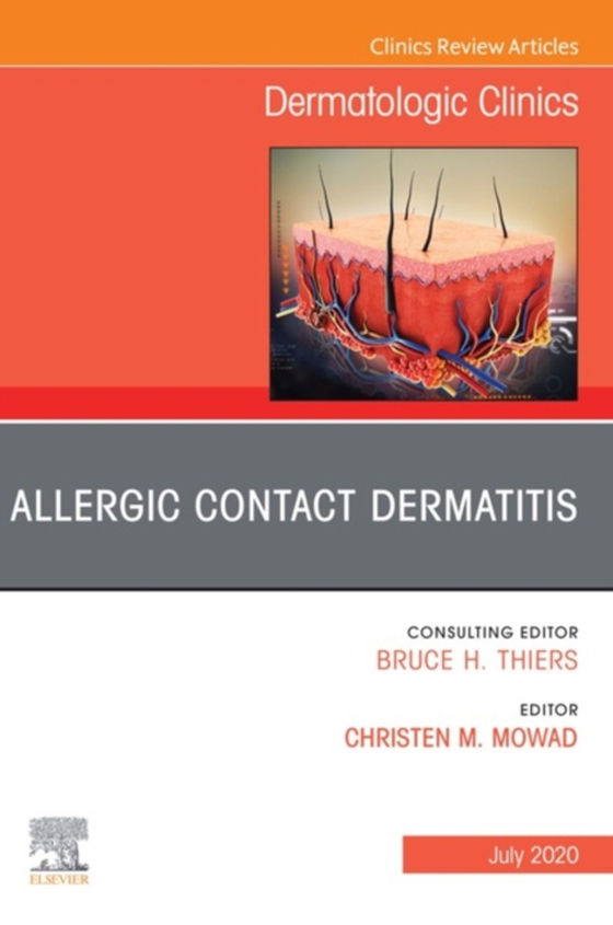 Allergic Contact Dermatitis,An Issue of Dermatologic Clinics - E-Book (e-bog) af Mowad, Christen M.