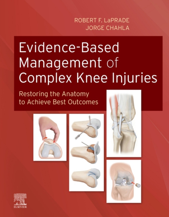 Evidence-Based Management of Complex Knee Injuries E-Book (e-bog) af -