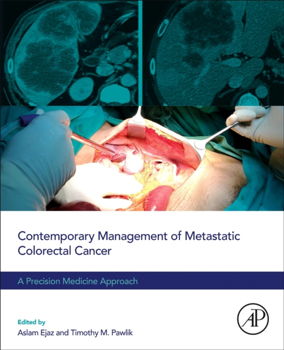 Contemporary Management of Metastatic Colorectal Cancer (e-bog) af -