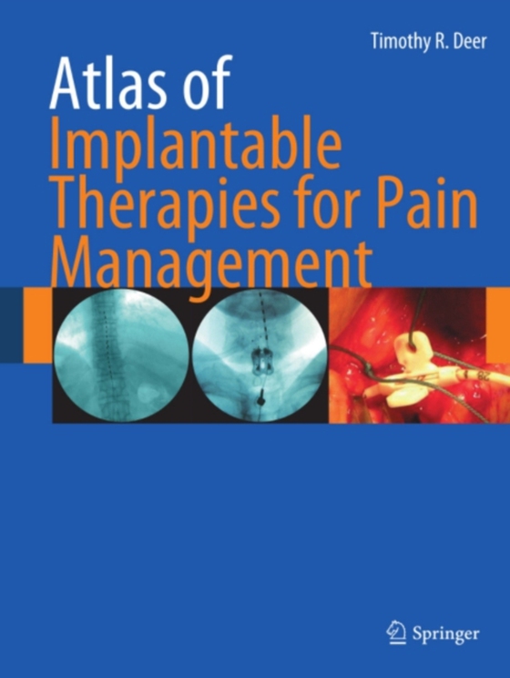 Atlas of Implantable Therapies for Pain Management