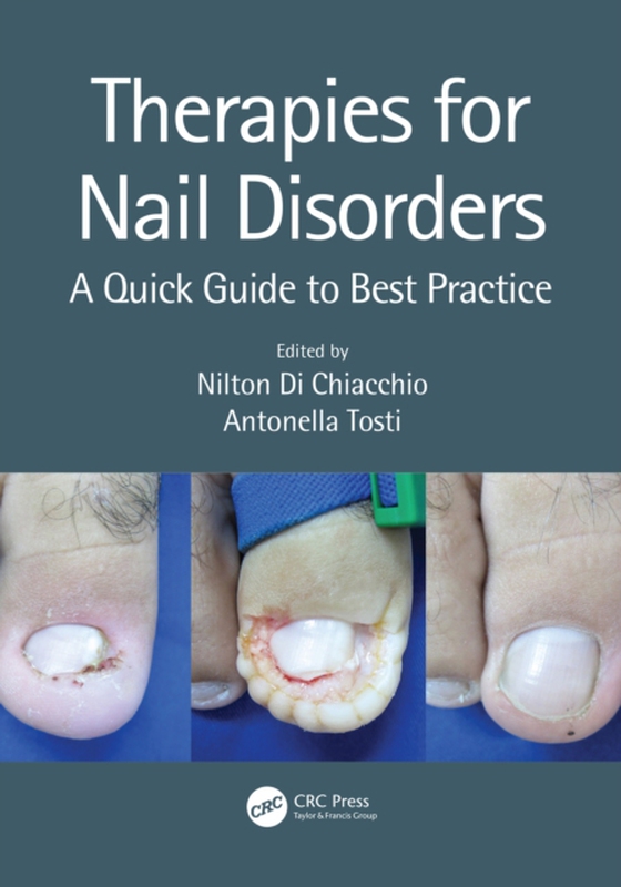 Therapies for Nail Disorders (e-bog) af -