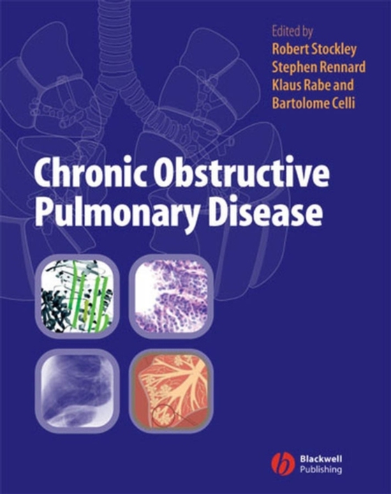 Chronic Obstructive Pulmonary Disease (e-bog) af -