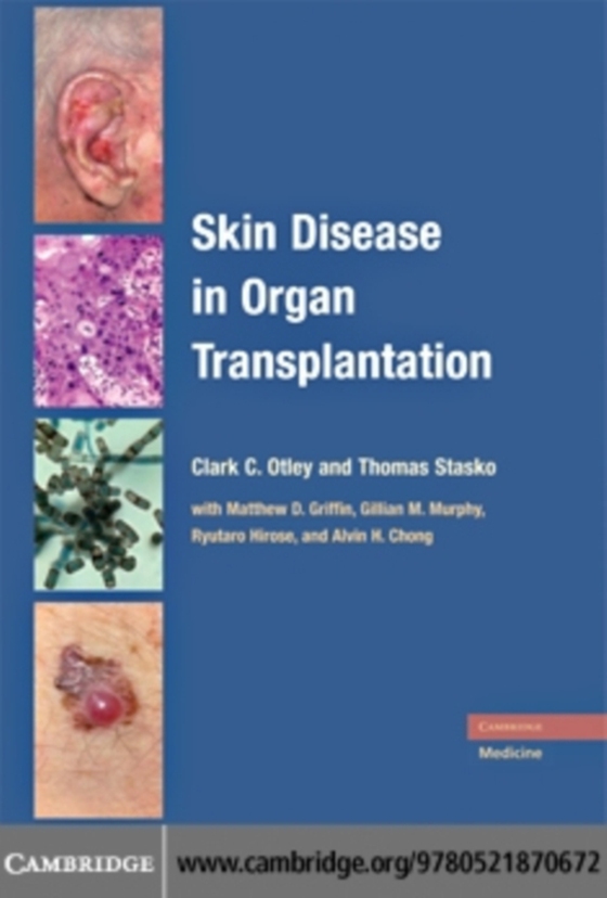 Skin Disease in Organ Transplantation (e-bog) af -