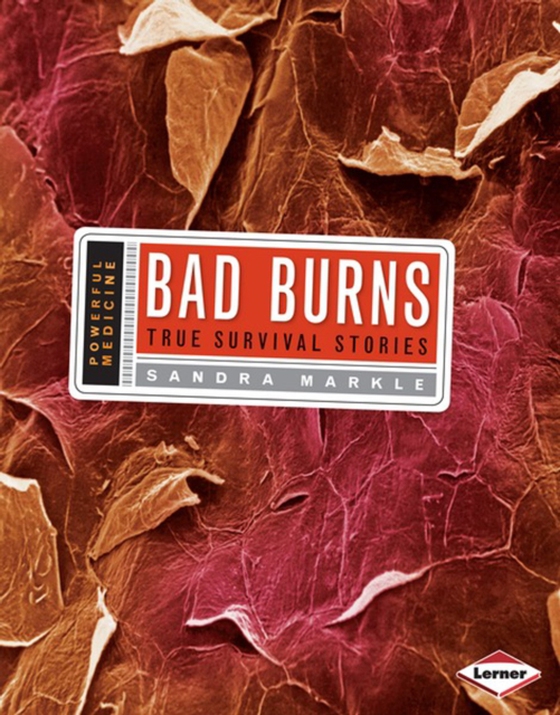 Bad Burns