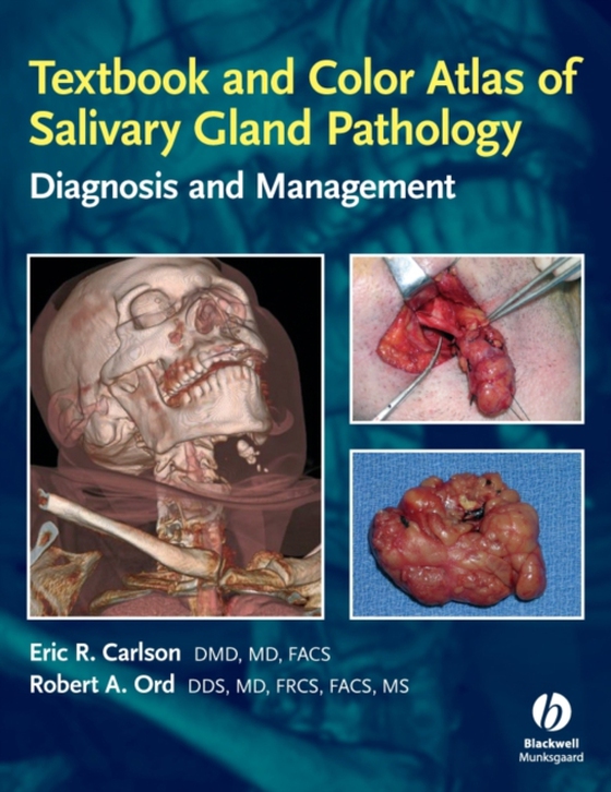 Textbook and Color Atlas of Salivary Gland Pathology (e-bog) af Ord, Robert