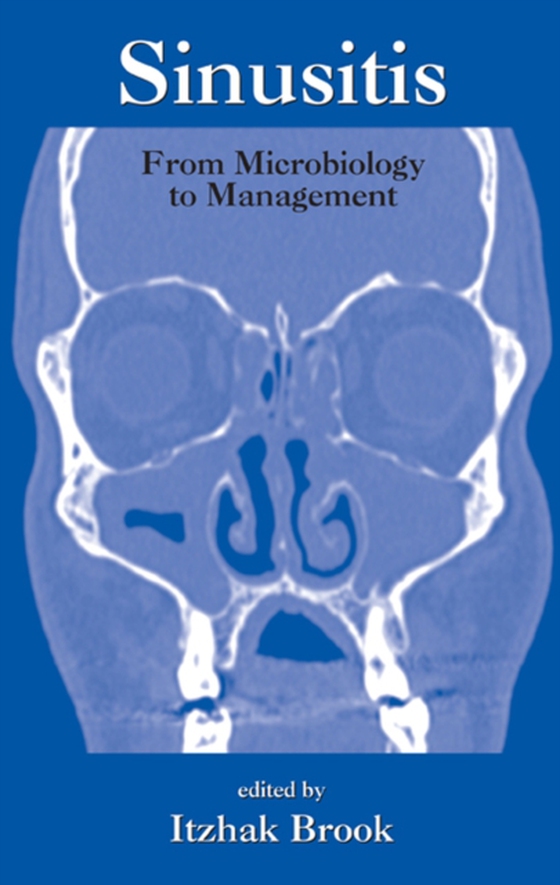 Sinusitis