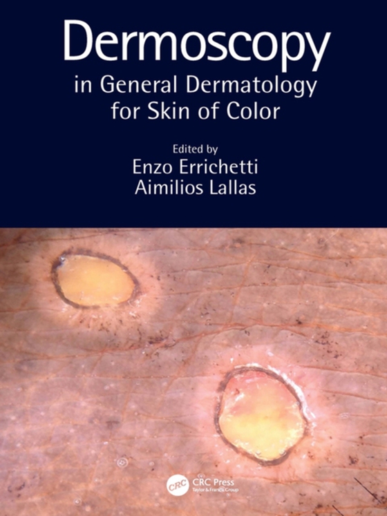 Dermoscopy in General Dermatology for Skin of Color (e-bog) af -