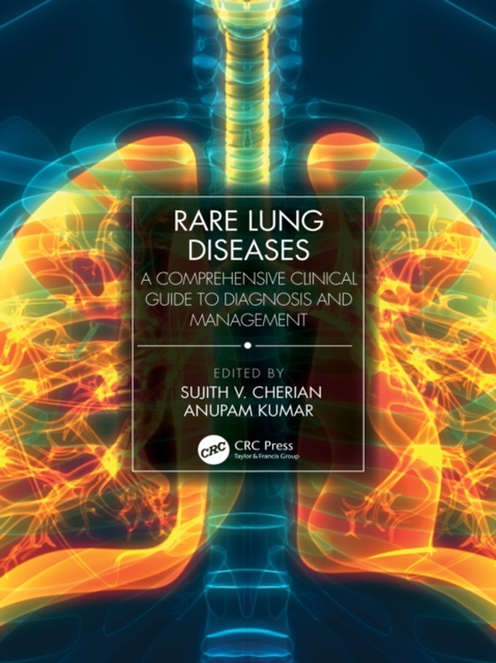 Rare Lung Diseases (e-bog) af -