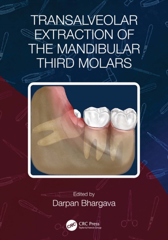 Transalveolar Extraction of the Mandibular Third Molars