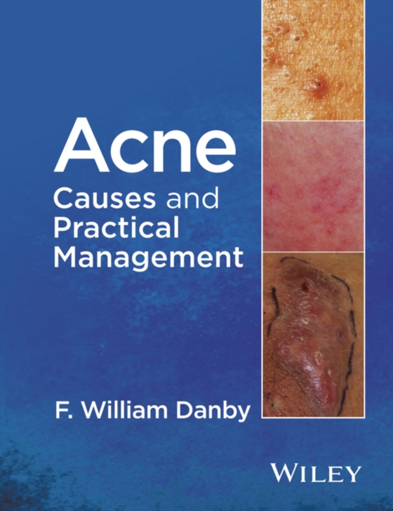 Acne (e-bog) af Danby, F. William