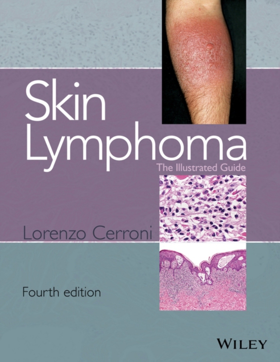 Skin Lymphoma (e-bog) af Cerroni, Lorenzo