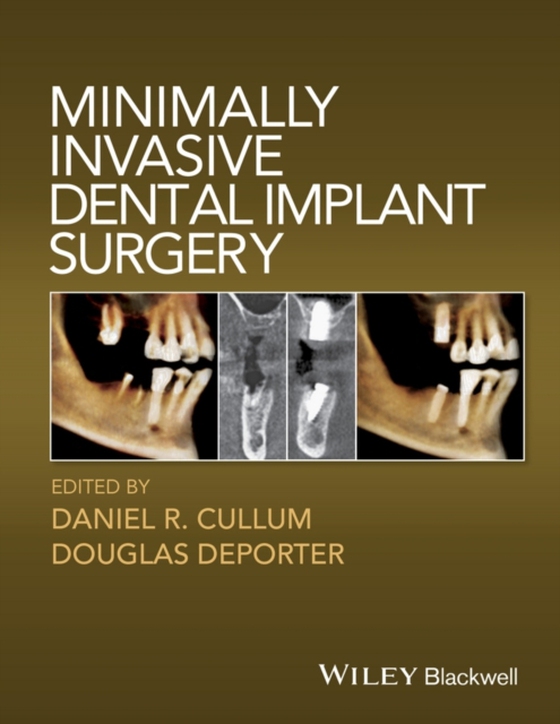 Minimally Invasive Dental Implant Surgery (e-bog) af -