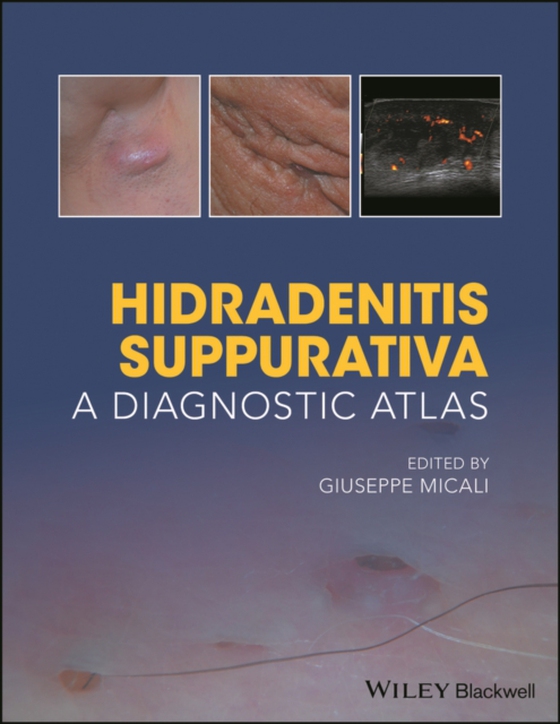 Hidradenitis Suppurativa