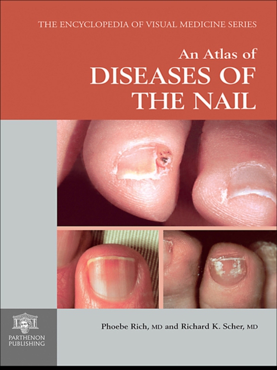 Atlas of Diseases of the Nail (e-bog) af Scher, Richard K.