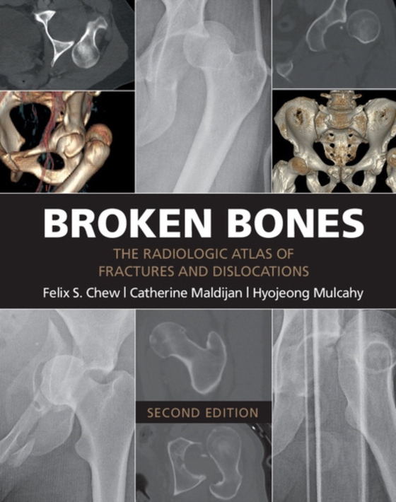 Broken Bones