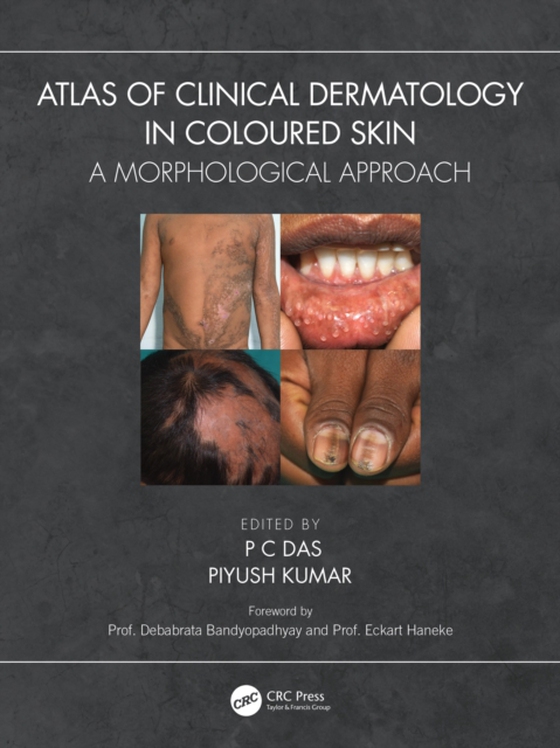 Atlas of Clinical Dermatology in Coloured Skin (e-bog) af -