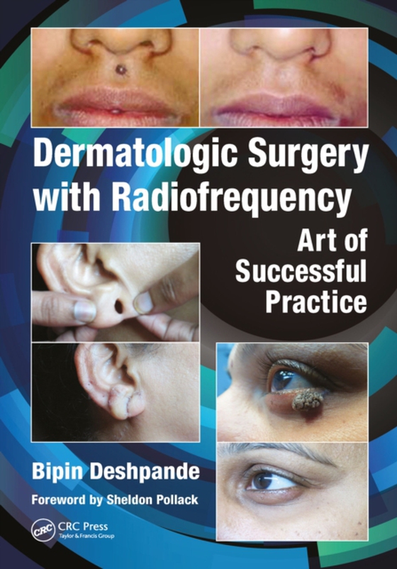 Dermatologic Surgery with Radiofrequency (e-bog) af Deshpande, Bipin