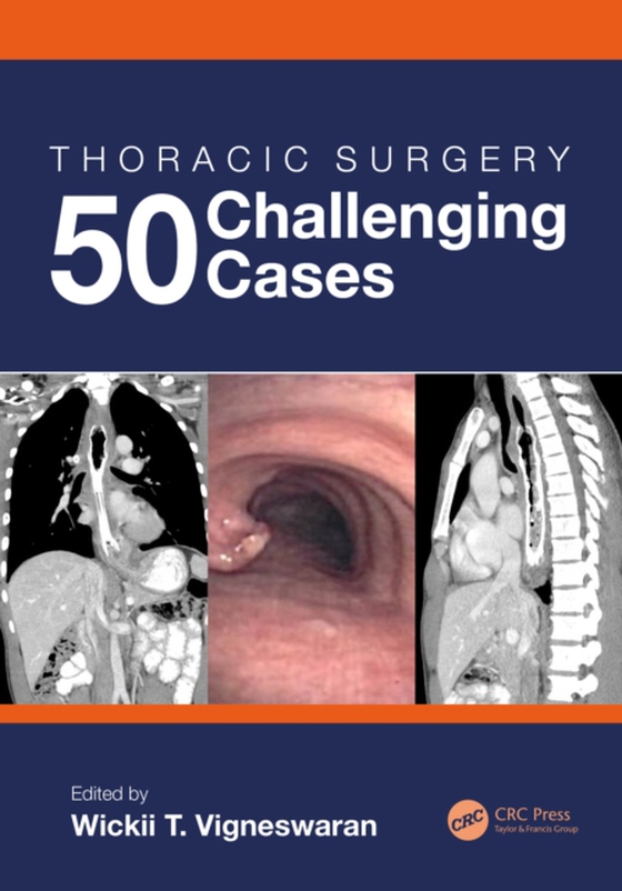 Thoracic Surgery: 50 Challenging cases (e-bog) af -